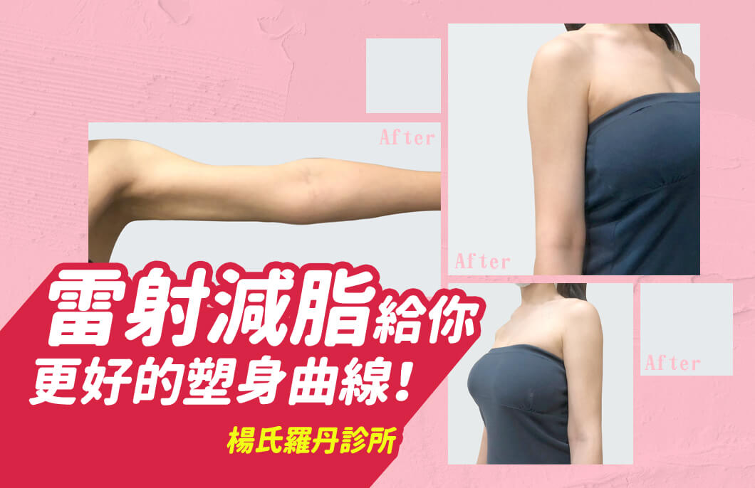 【雷射減脂】一舉兩得，雷射減脂給你更好的塑身曲線！