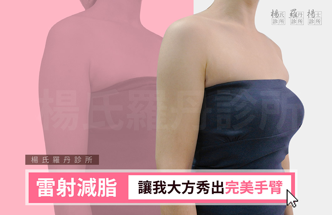 【雷射減脂】讓我大方秀出完美手臂