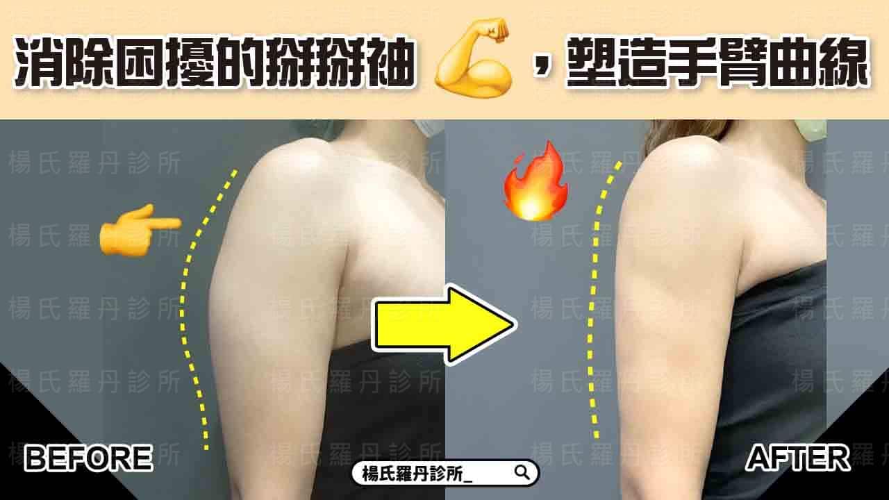 【雷射減脂】消除困擾的掰掰袖，塑造迷人手臂曲線美感