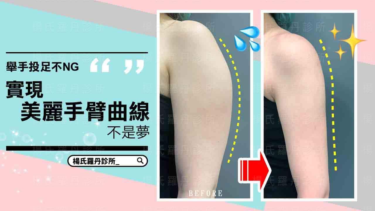 【雷射減脂】舉手投足不NG，實現美麗手臂曲線不是夢