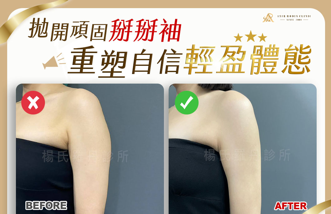 【雷射減脂】拋開頑固掰掰袖，重塑自信迷人的輕盈體態