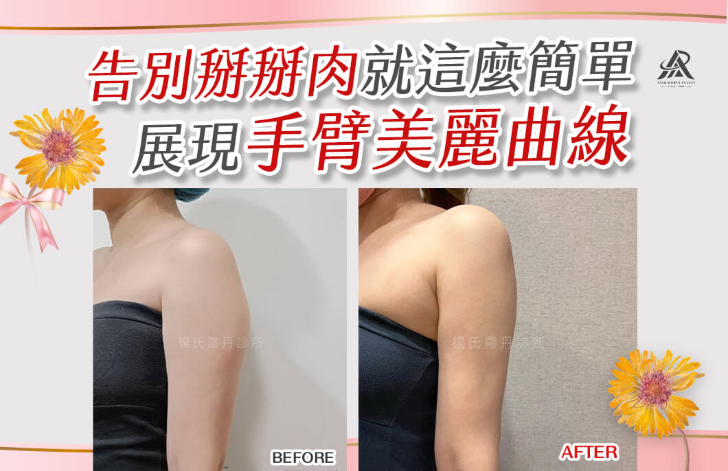 【雷射減脂】告別掰掰肉就這麼簡單，展現手臂美麗曲線