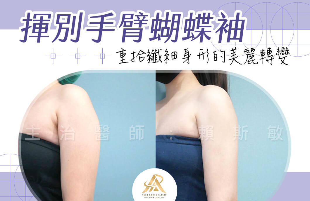 【雷射減脂】揮別手臂蝴蝶袖，重拾纖細身形的美麗轉變