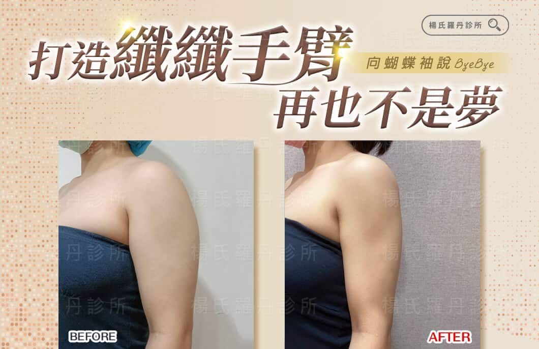 【雷射減脂】向蝴蝶袖說掰掰！打造纖纖手臂再也不是夢