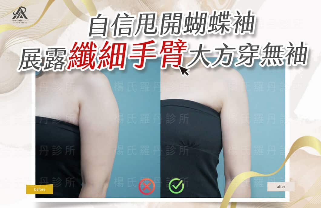 【雷射減脂】自信甩開蝴蝶袖，展露纖細手臂大方穿無袖