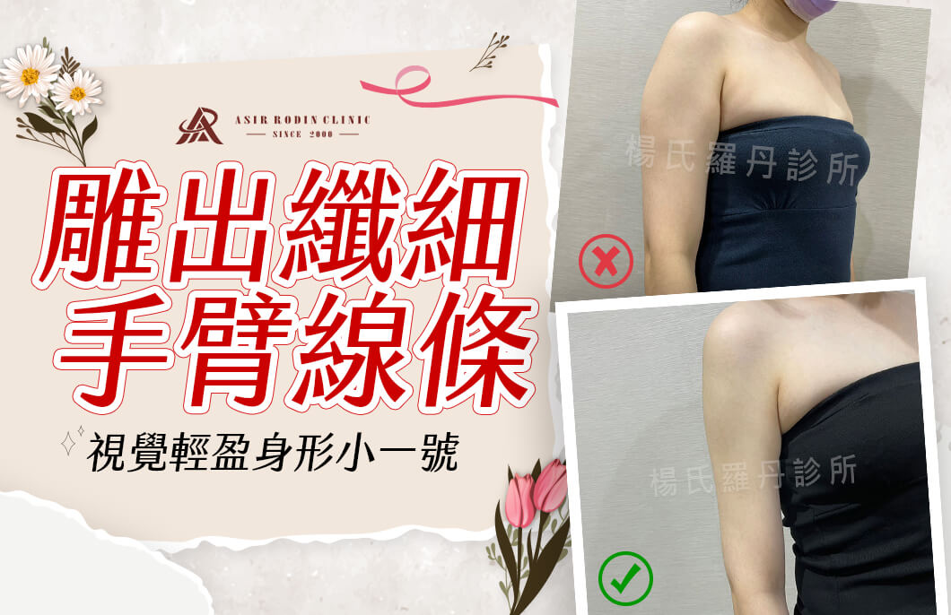 【雷射減脂】雕出纖細手臂線條，視覺輕盈身形小一號！
