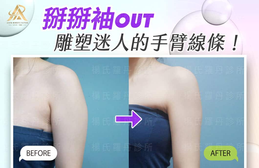【雷射減脂】掰掰袖OUT，輕鬆雕塑迷人的手臂線條！