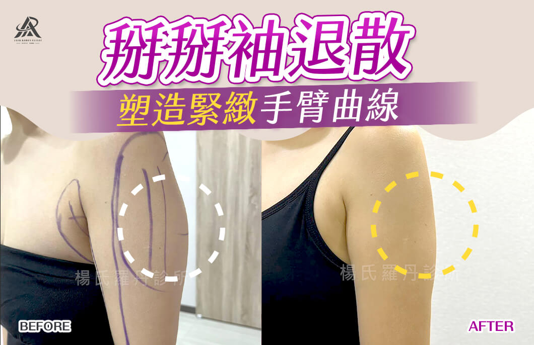 【雷射減脂】掰掰袖退散，塑造緊緻手臂曲線展現自信！