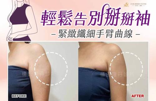 【雷射減脂】緊緻纖細手臂曲線，輕鬆告別鬆垂掰掰袖！
