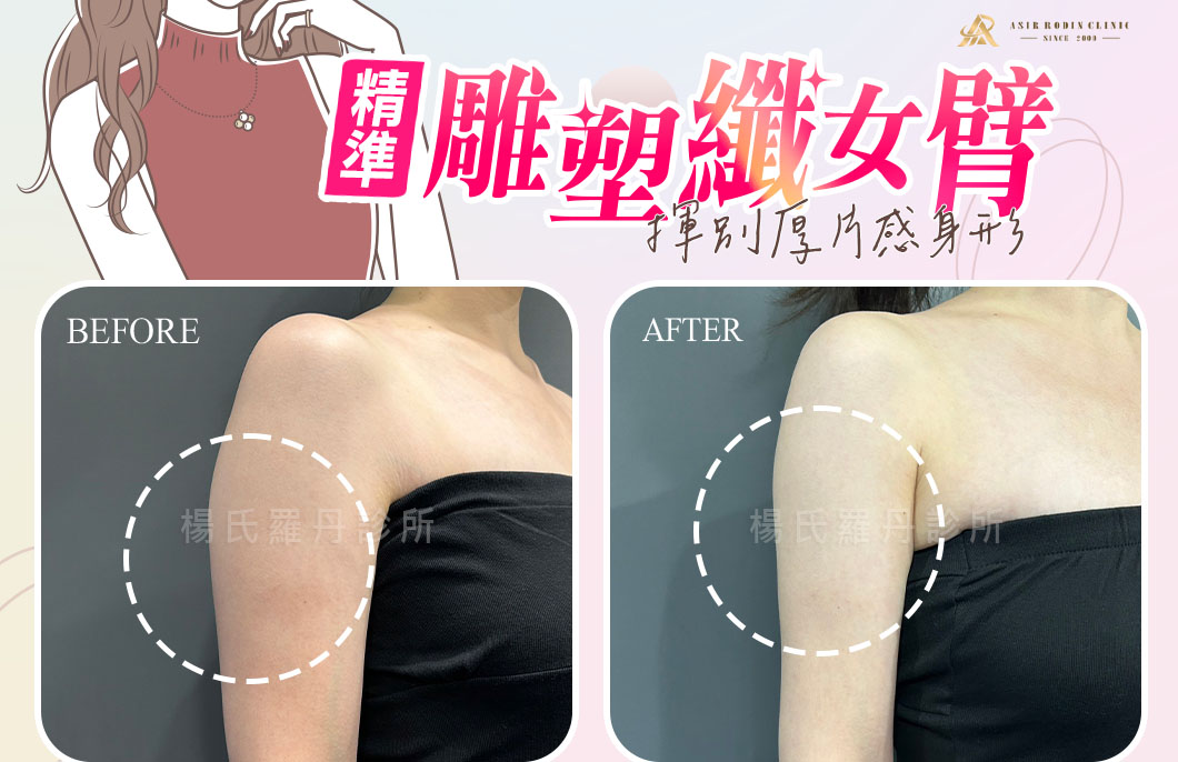 【雷射減脂】揮別厚片感身形，精準雕塑重拾優雅「纖」女臂