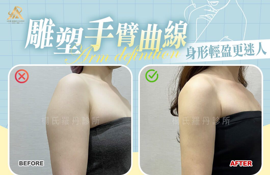 【雷射減脂】精準雕塑手臂曲線，身形輕盈比例更迷人！