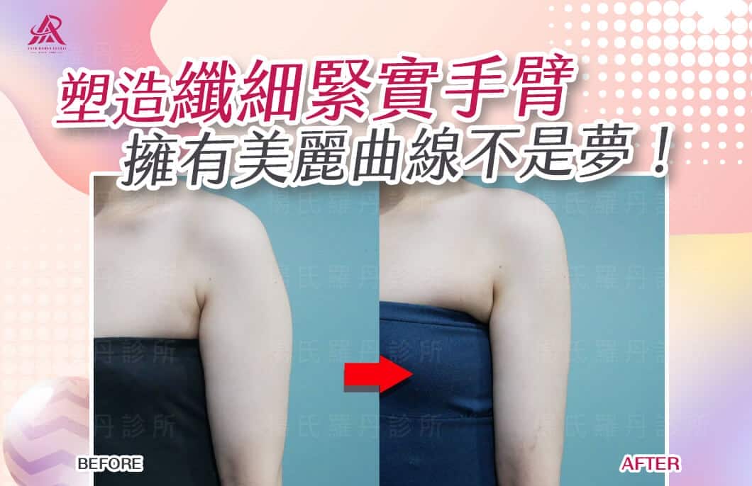 【雷射減脂】塑造纖細緊實手臂，擁有美麗曲線不是夢！