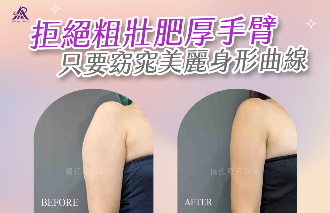 【雷射減脂】拒絕粗壯肥厚手臂，只要窈窕美麗身形曲線