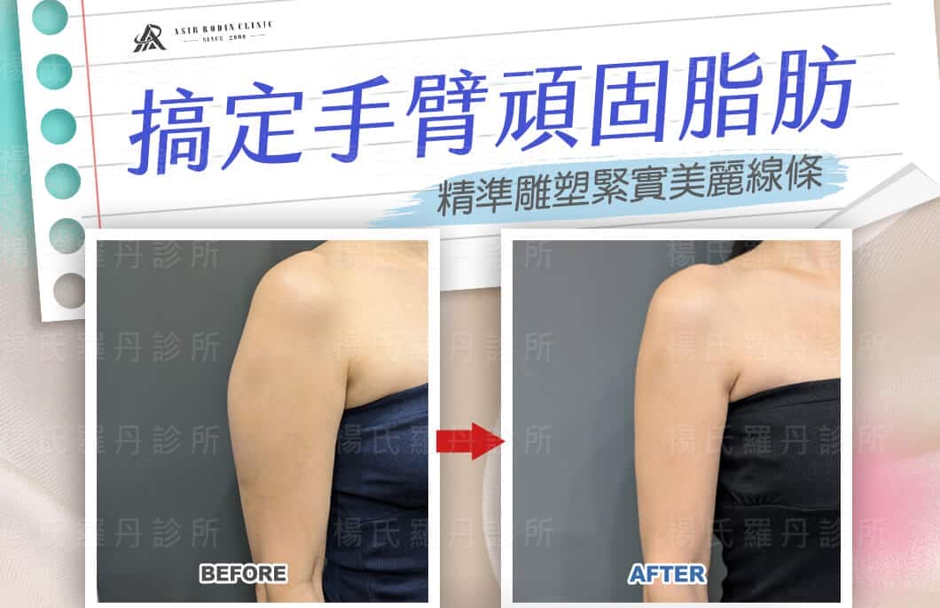 【雷射減脂】搞定手臂頑固脂肪，精準雕塑緊實美麗線條