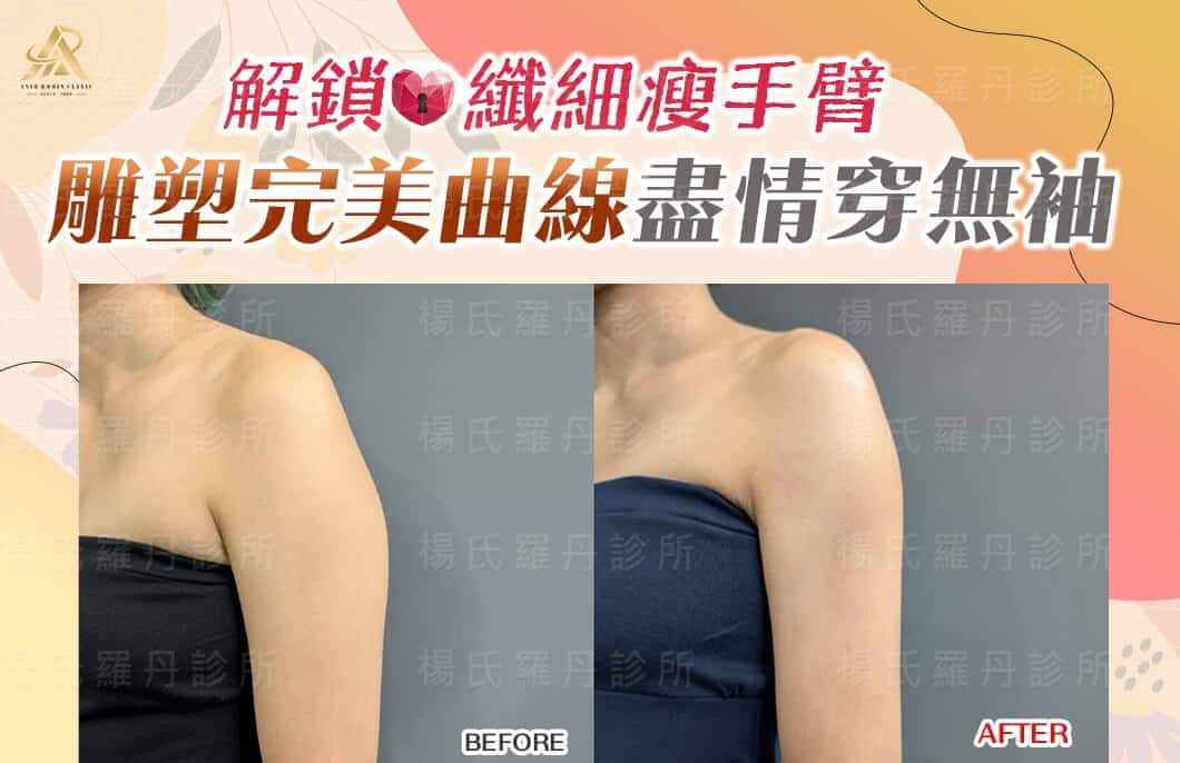 【雷射減脂】解鎖纖細瘦手臂，雕塑完美曲線盡情穿無袖