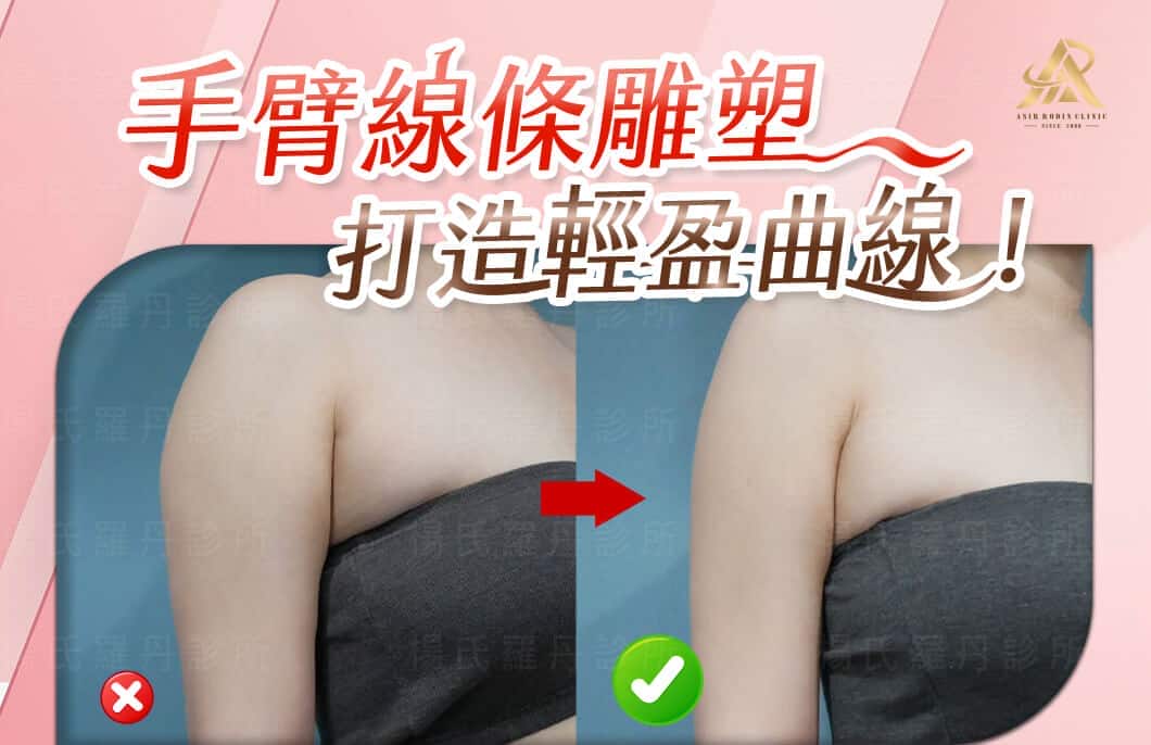 【雷射減脂】手臂線條雕塑，打造輕盈曲線與穿衣自信！
