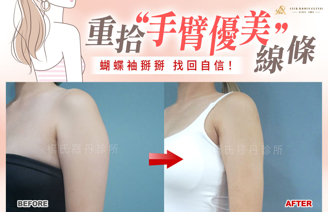 【雷射減脂】蝴蝶袖掰掰，重拾手臂優美線條找回自信！