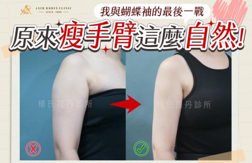 【雷射減脂】原來瘦手臂這麼自然！我與蝴蝶袖的最後一戰