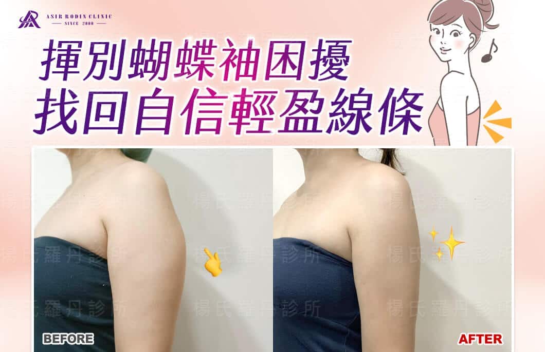 【雷射減脂】揮別手臂蝴蝶袖困擾，找回自信輕盈線條！