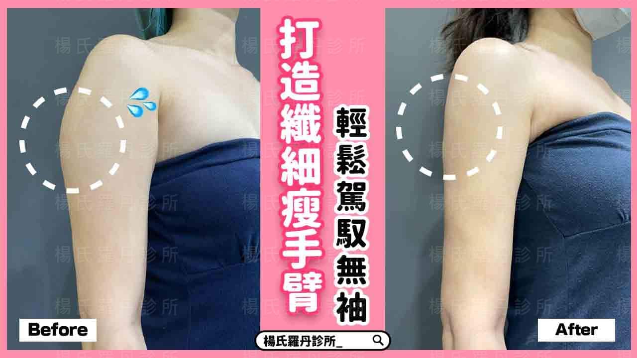 【雷射減脂】打造纖細瘦手臂，輕鬆駕馭無袖背心更顯瘦
