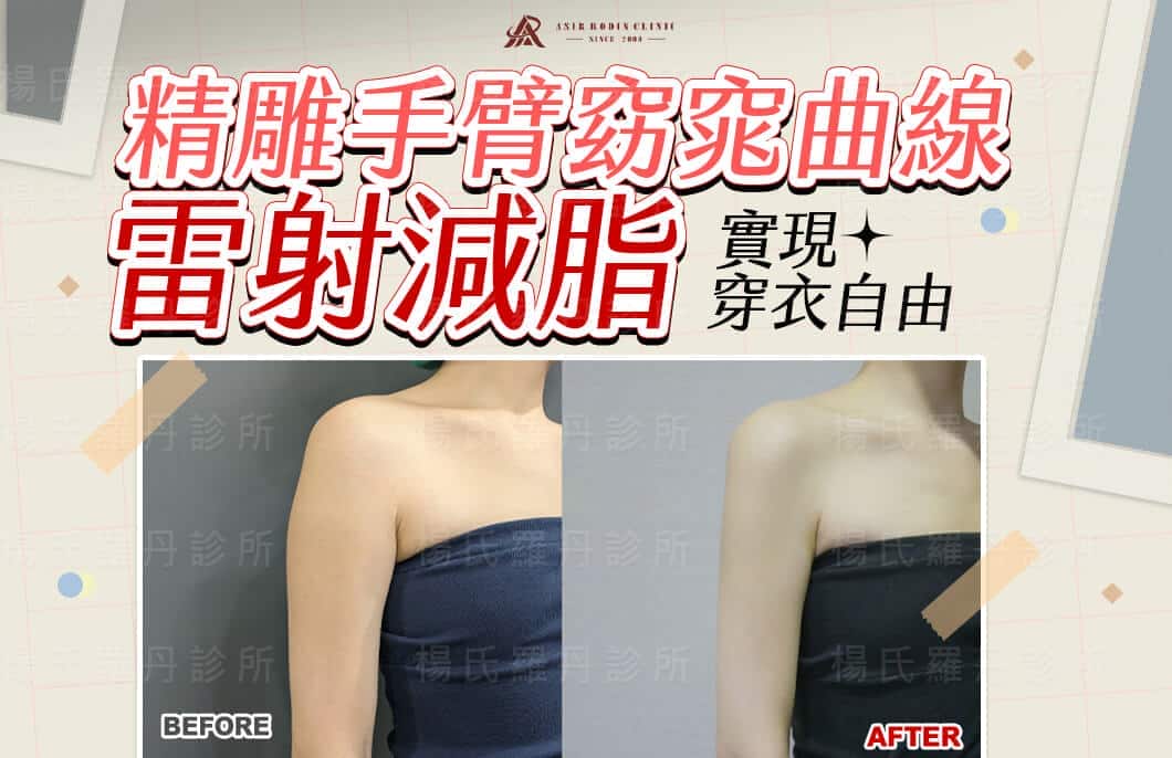 【雷射減脂】精雕手臂窈窕曲線，雷射減脂實現穿衣自由