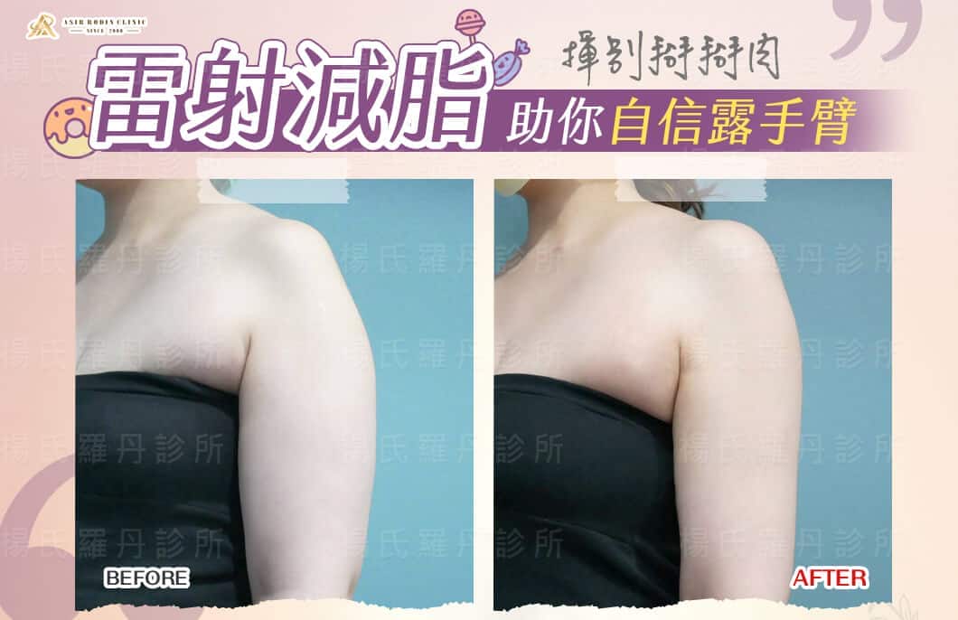 【雷射減脂】揮別掰掰肉，雷射減脂助你自信露手臂秀一夏