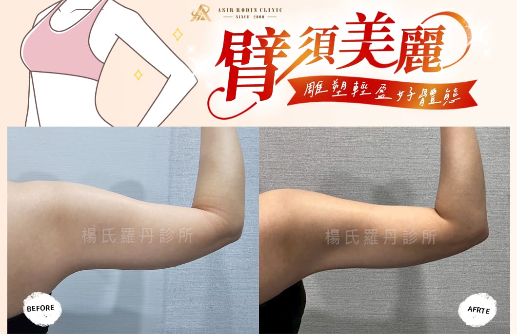 【雷射減脂】「臂」須美麗，精準雕塑展露輕盈好體態！