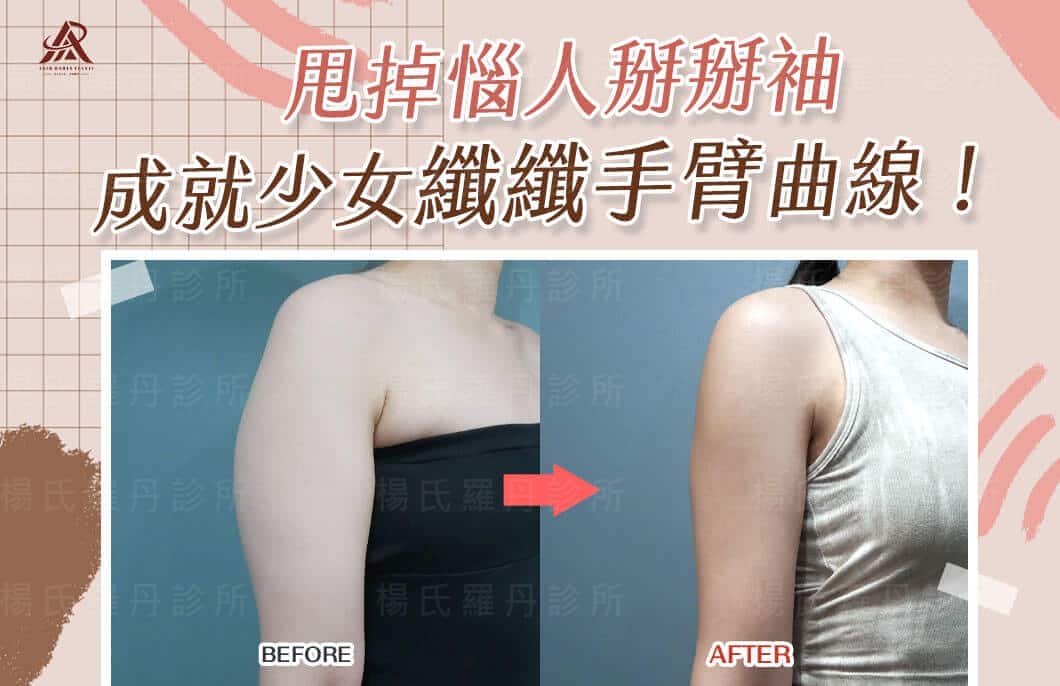 【雷射減脂】甩掉惱人掰掰袖，成就少女纖纖手臂曲線！