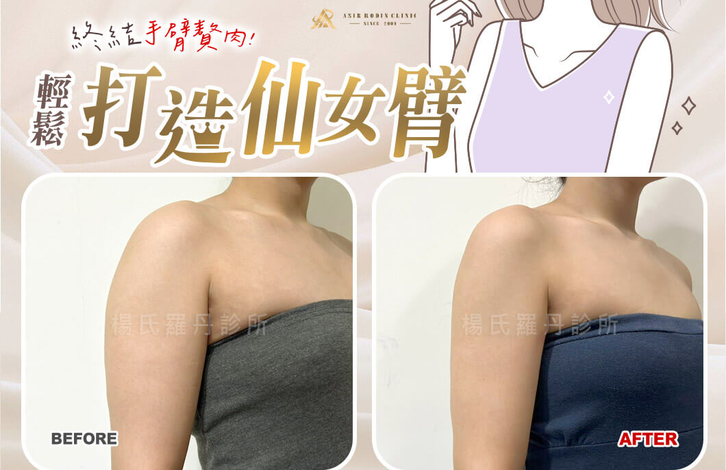 【雷射減脂】終結手臂贅肉，輕鬆打造完美比例仙女臂！