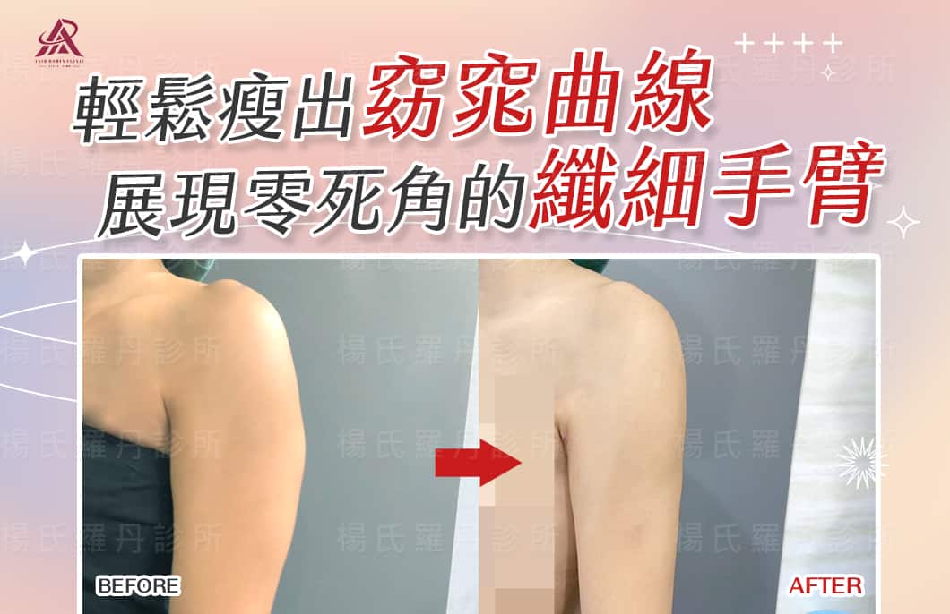 【雷射減脂】輕鬆瘦出窈窕曲線，展現零死角的纖細手臂