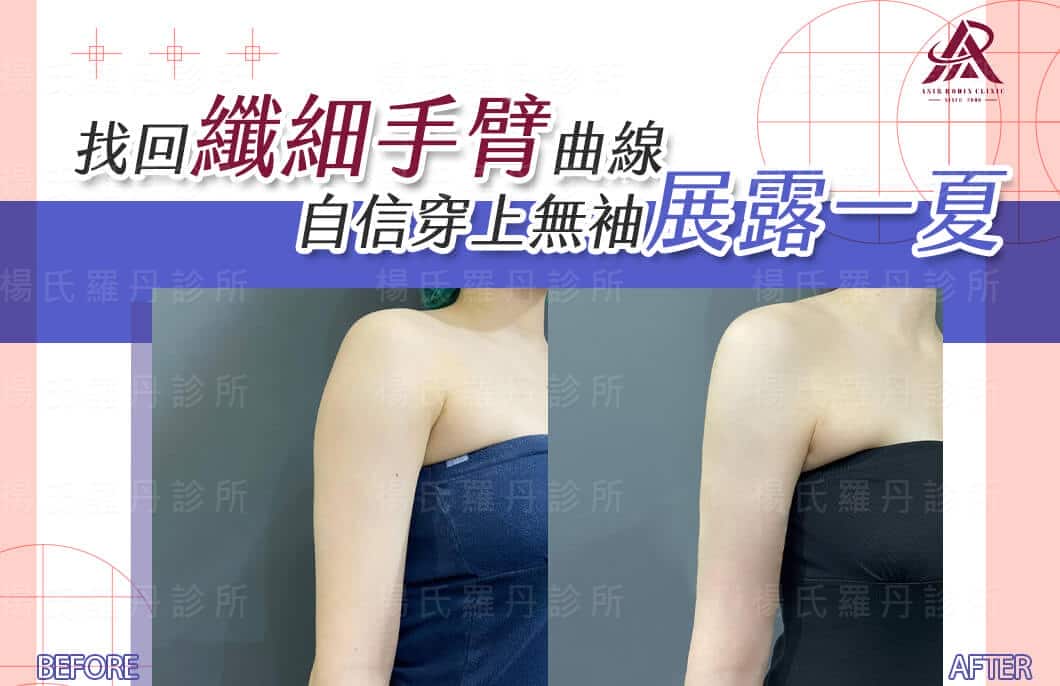【雷射減脂】找回纖細手臂曲線，自信穿上無袖展露一夏
