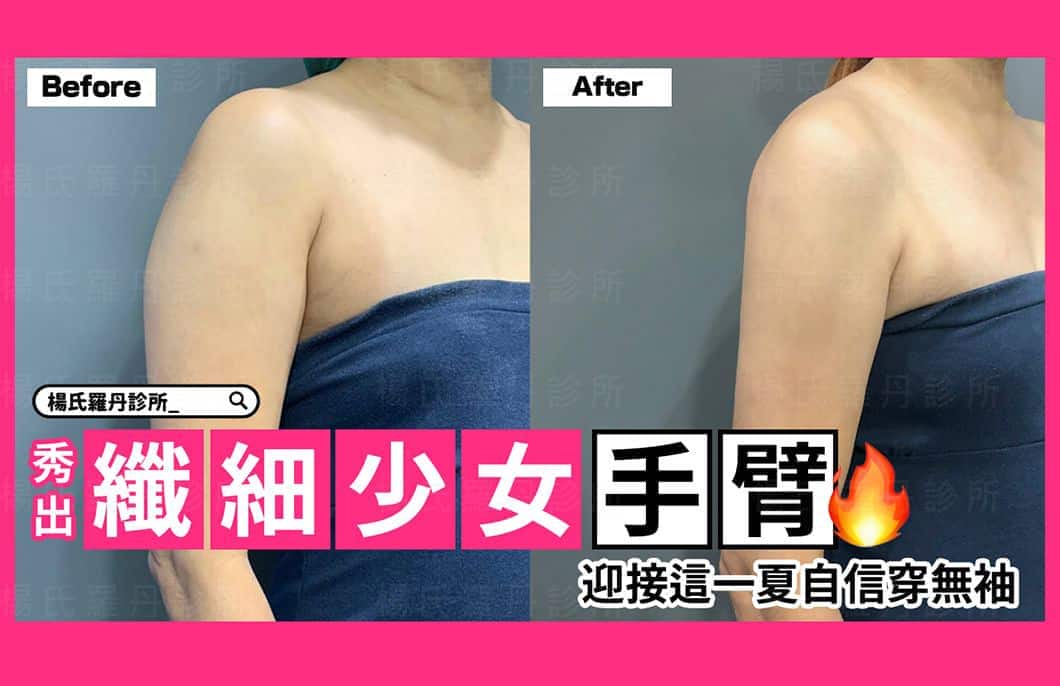 【雷射減脂】秀出纖細少女手臂，迎接這一夏自信穿無袖