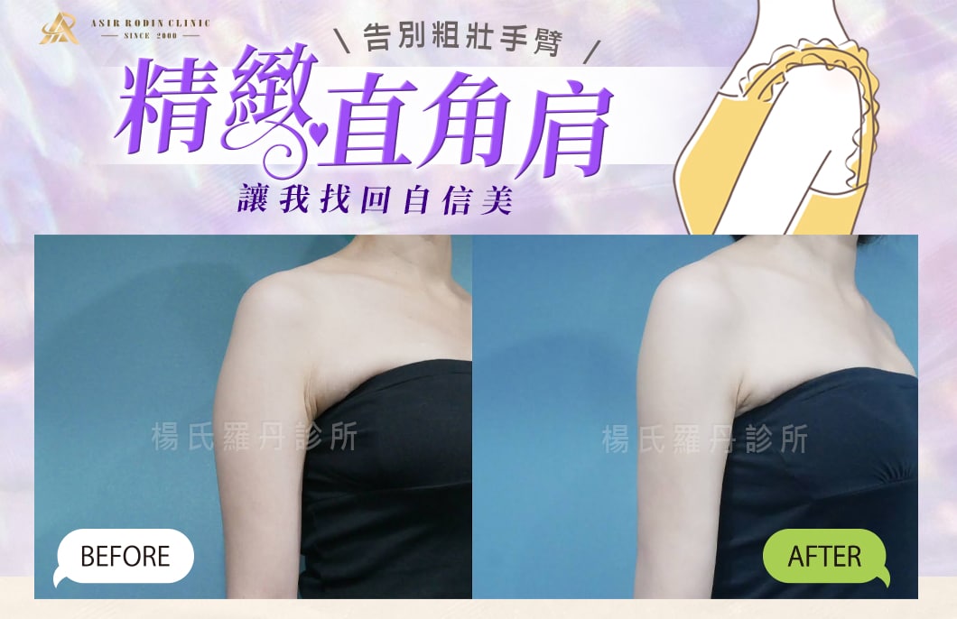 【雷射減脂】告別粗壯手臂，精緻直角肩讓我找回自信美