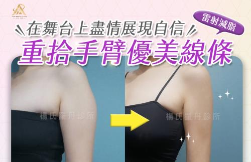 【雷射減脂】重拾手臂優美線條，在舞台上盡情展現自信