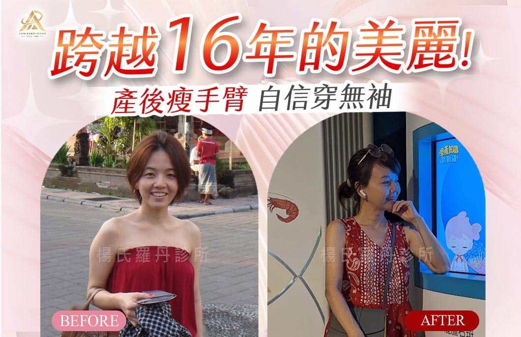【雷射減脂】跨越16年的美麗！產後瘦手臂，自信穿無袖
