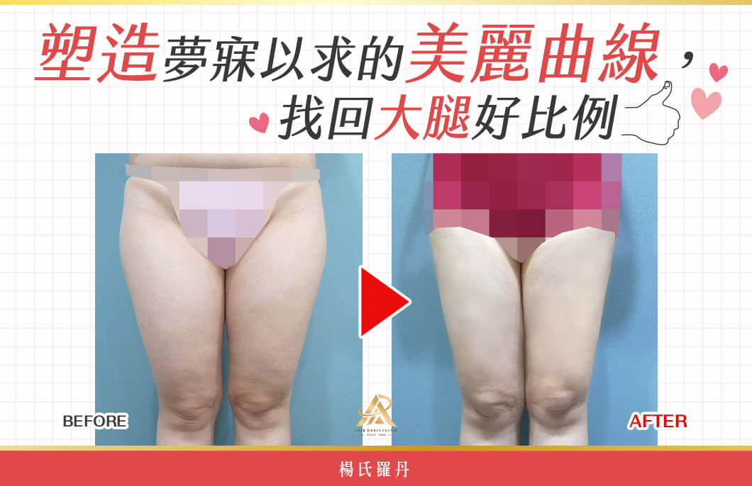 【雷射減脂】塑造夢寐以求的美麗曲線，找回大腿好比例