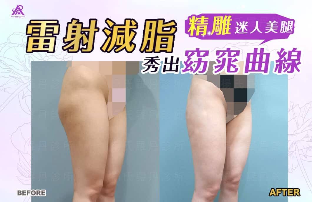 【雷射減脂】精雕迷人美腿，雷射減脂輕鬆秀出窈窕曲線