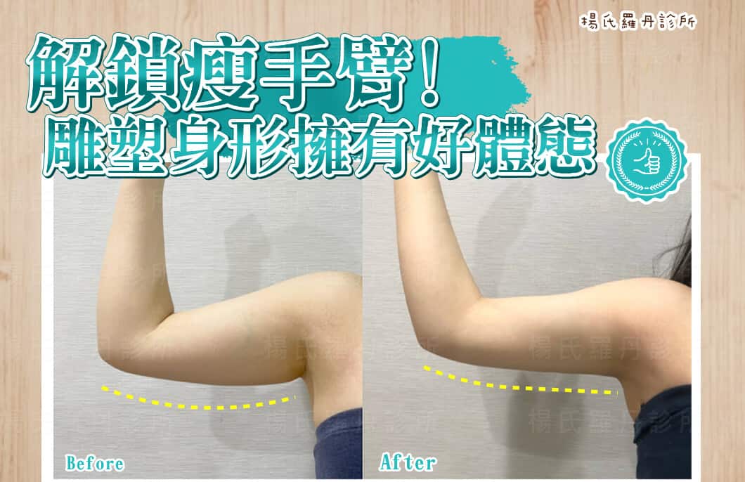 【雷射減脂】解鎖理想中的瘦手臂，雕塑身形擁有好體態