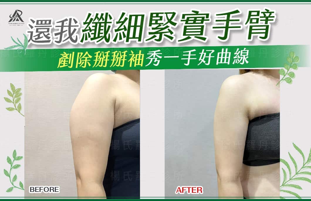 【雷射減脂】還我纖細緊實手臂，剷除掰掰袖秀一手好曲線