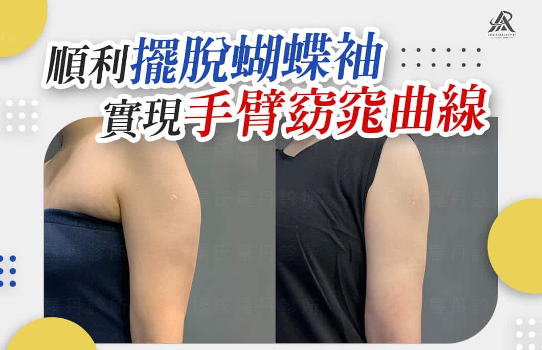 【雷射減脂】順利擺脫蝴蝶袖，實現手臂窈窕曲線自信迎夏
