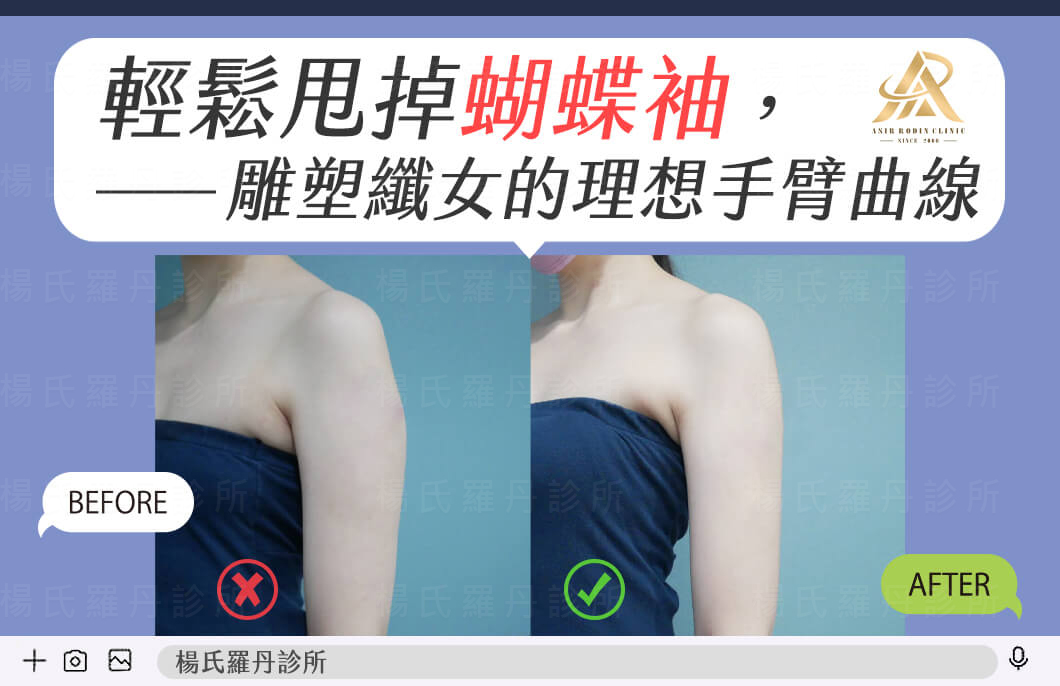 【雷射減脂】輕鬆甩掉蝴蝶袖，雕塑纖女的理想手臂曲線