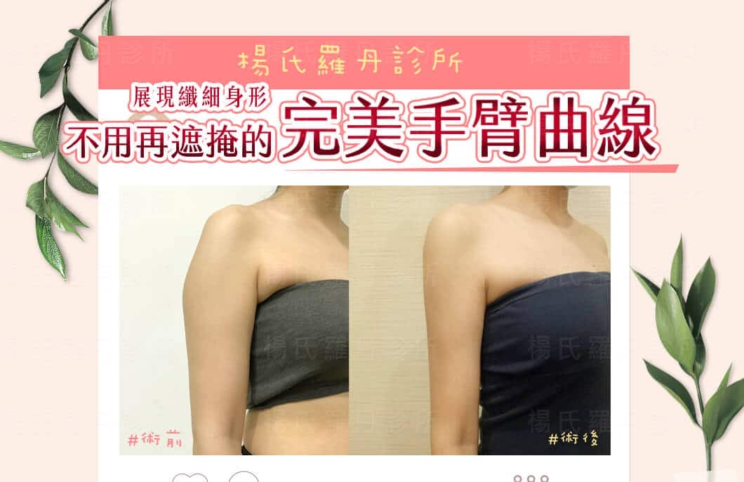 【雷射減脂】不用再遮掩的完美手臂曲線，展現纖細身形