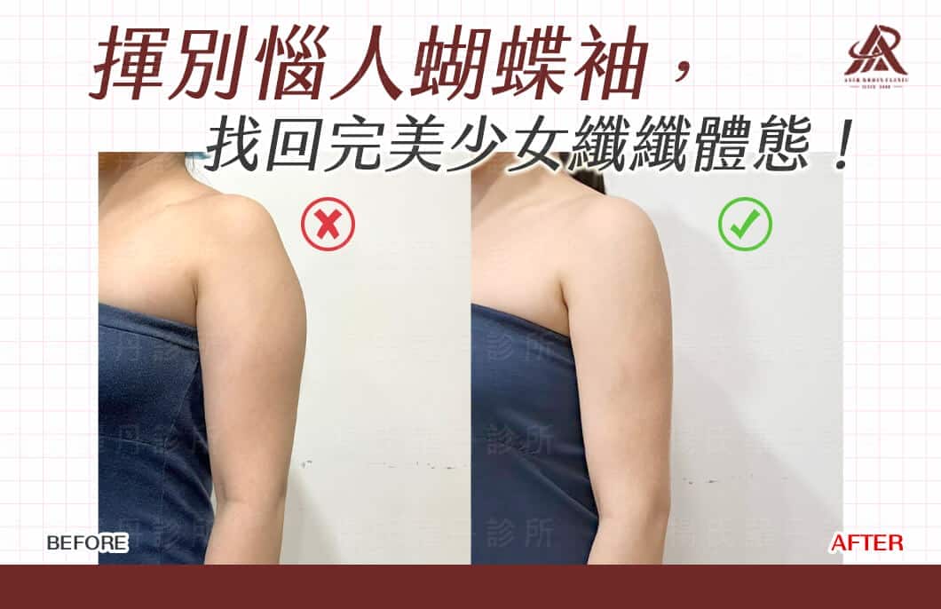 【雷射減脂】揮別惱人蝴蝶袖，找回完美少女纖纖體態！