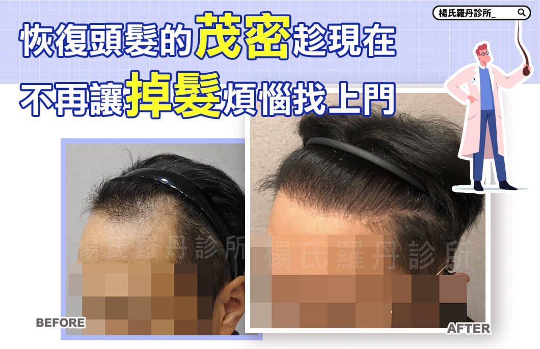 【植髮】恢復頭髮的茂密趁現在，不再讓掉髮煩惱找上門