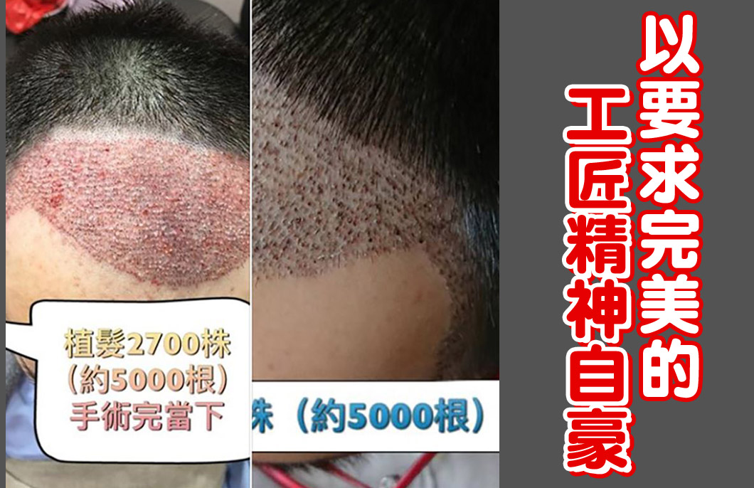 【植髮】楊名權醫師： 以要求完美的工匠精神自豪