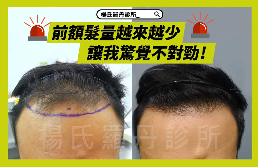 【植髮】大量掉髮讓我驚覺不對勁！