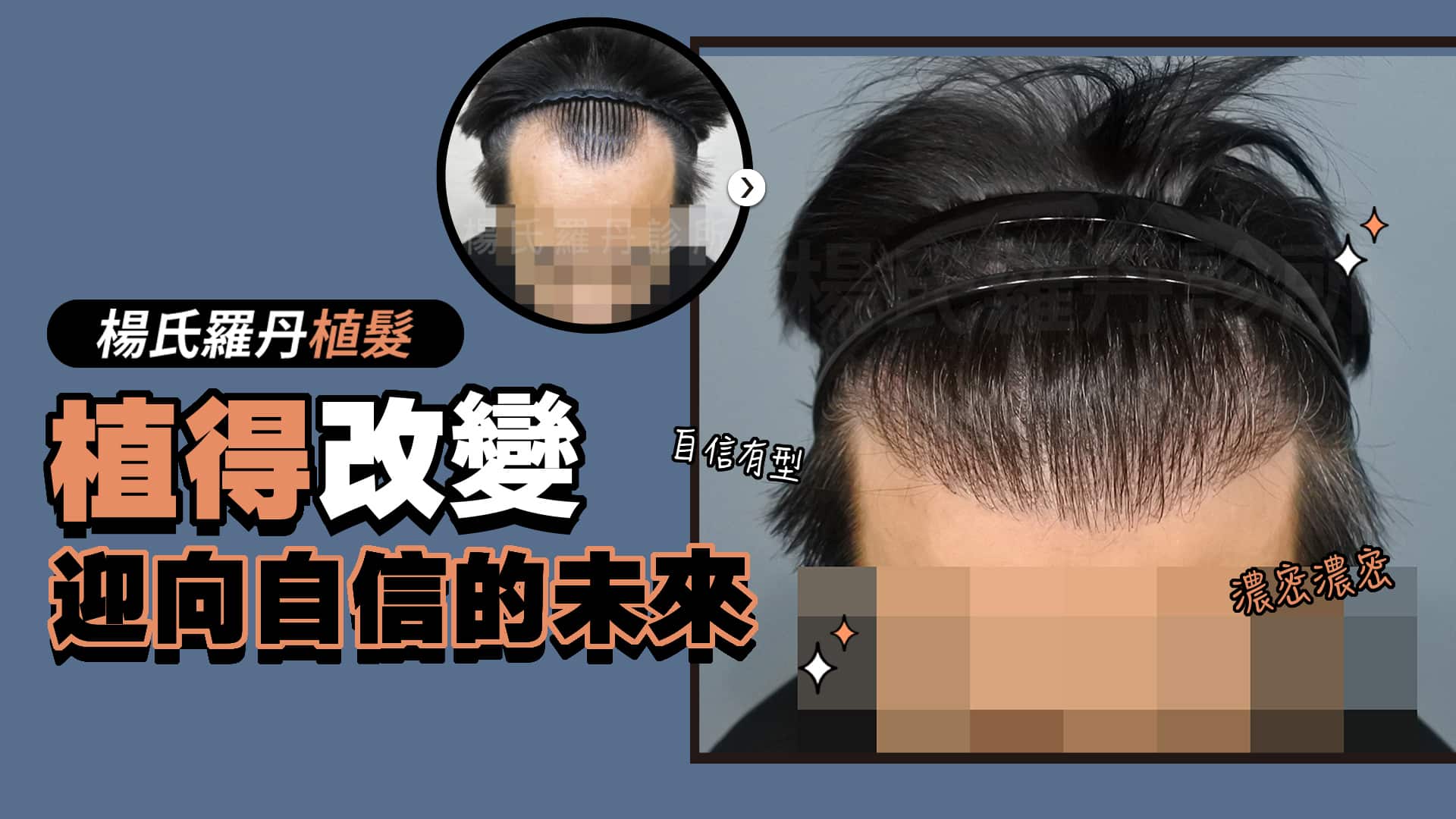 【植髮】植得改變，迎向自信的未來