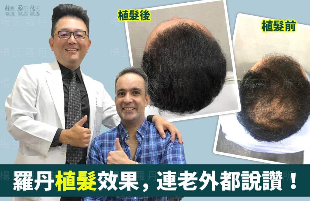 【植髮】羅丹複合式生髮與植髮效果，連老外都說讚！