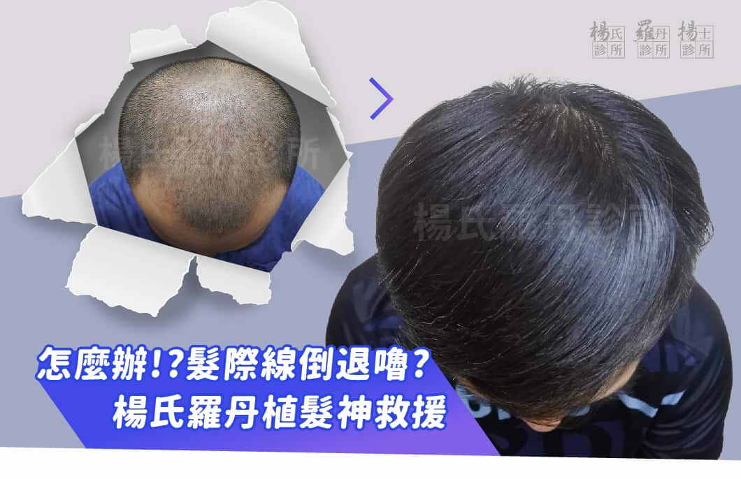 【植髮】髮際線倒退嚕?別怕，楊氏羅丹植髮神救援!