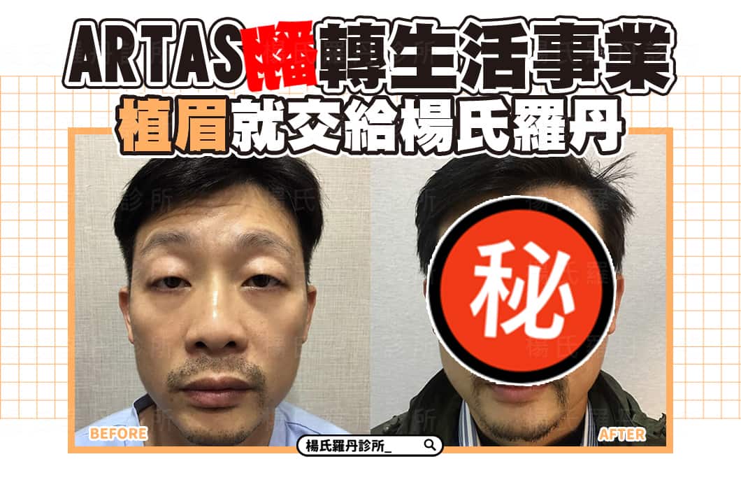 【植髮】ARTAS翻轉生活事業 植眉就交給楊氏羅丹